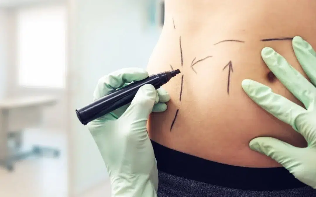 plastic surgeon marking womans body for surgery