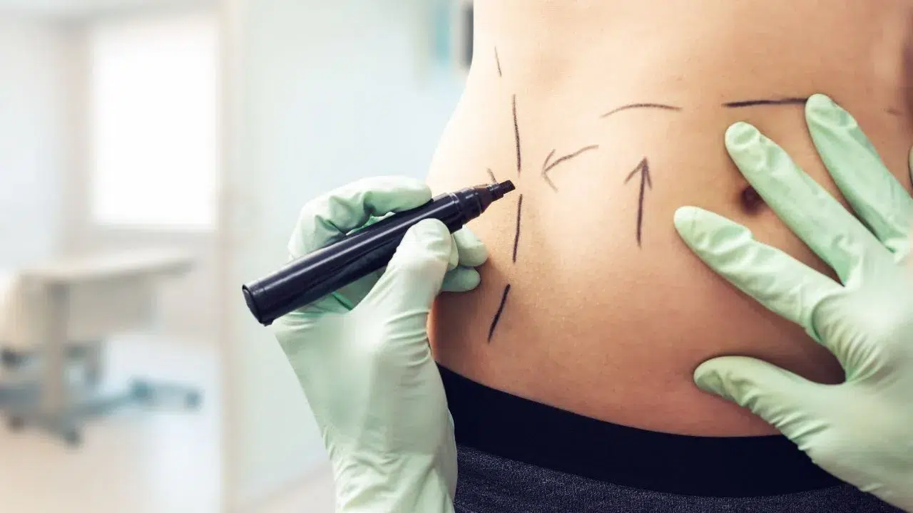 plastic surgeon marking womans body for surgery