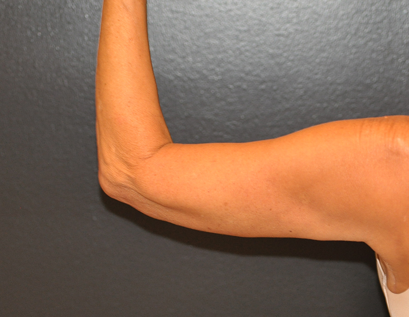 Back View Arm Lift Before and After Photo by Dr. Steely in Houston, TX