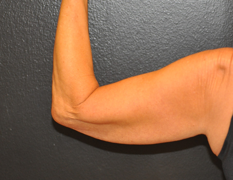 Back View Arm Lift Before and After Photo by Dr. Steely in Houston, TX