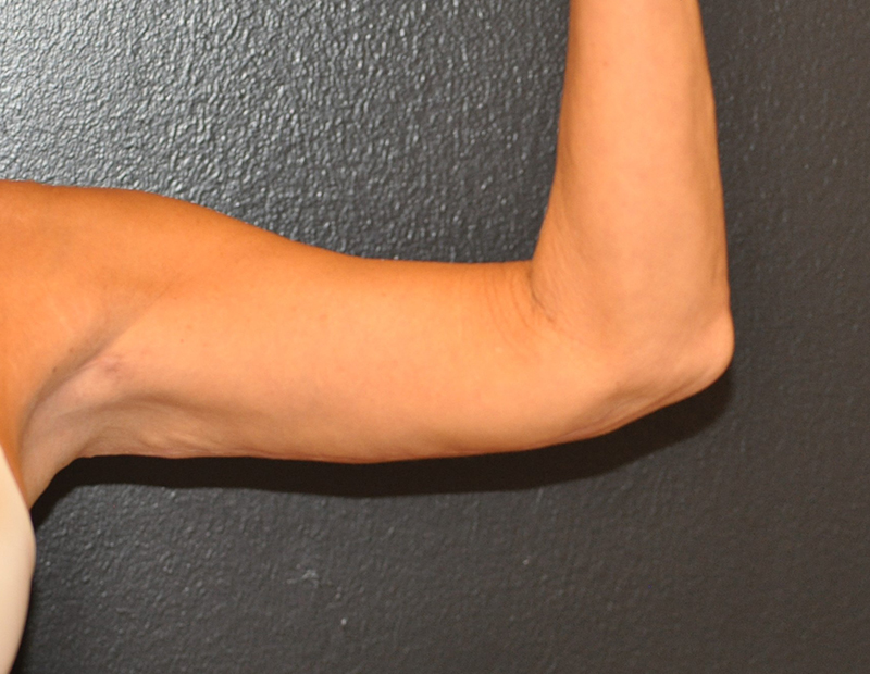 Front View Arm Lift Before and After Photo by Dr. Steely in Houston, TX