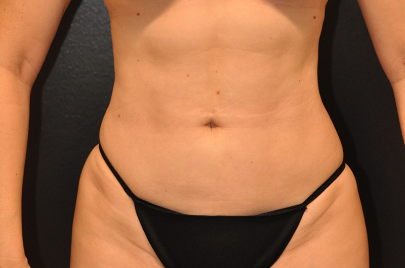Front View Liposculpting Before and After Photo by Dr. Steely in Houston, TX