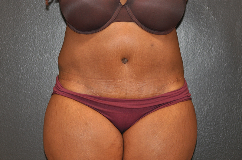 Front View Tummy Tuck Before and After Photo by Dr. Steely in Houston, TX