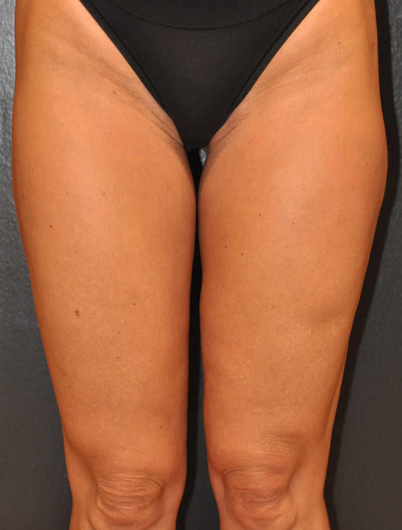 Front View Liposculpting Before and After Photo by Dr. Steely in Houston, TX
