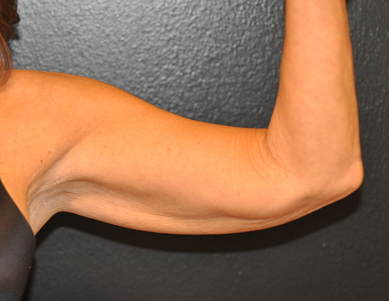 Front View Arm Lift Before and After Photo by Dr. Steely in Houston, TX