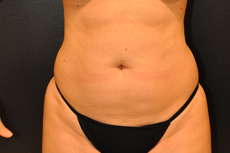 Front View Liposculpting Before and After Photo by Dr. Steely in Houston, TX