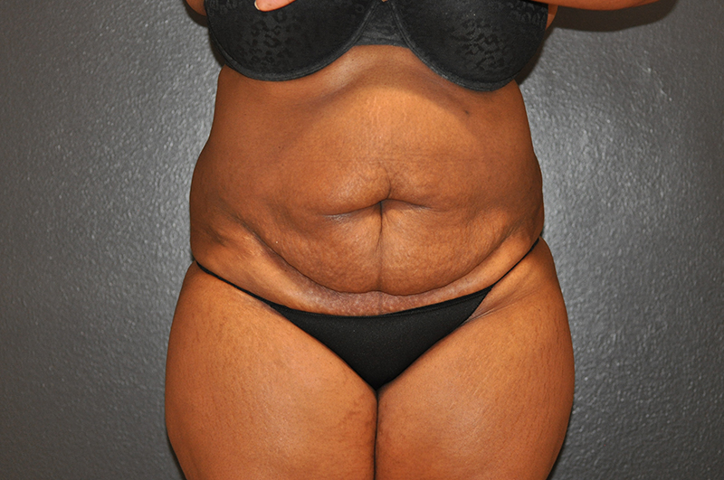 Front View Tummy Tuck Before and After Photo by Dr. Steely in Houston, TX