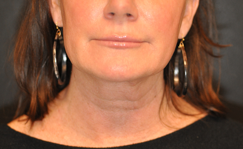 Front View Lower Facelift with Necklift Before and After Photo by Dr. Steely in Houston, TX
