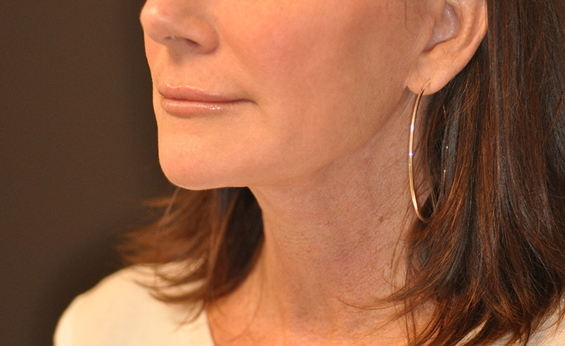 Left Oblique View Lower Facelift with Necklift Before and After Photo by Dr. Steely in Houston, TX