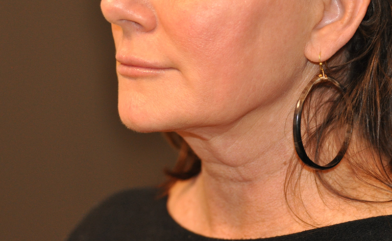 Left Oblique View Lower Facelift with Necklift Before and After Photo by Dr. Steely in Houston, TX