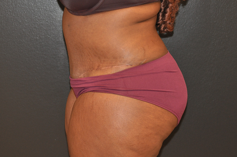 Left Side View Tummy Tuck Before and After Photo by Dr. Steely in Houston, TX