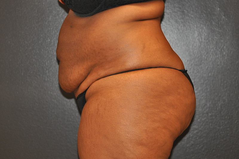Left Side View Tummy Tuck Before and After Photo by Dr. Steely in Houston, TX