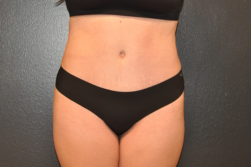 Front View Tummy Tuck Before and After Photo by Dr. Steely in Houston, TX