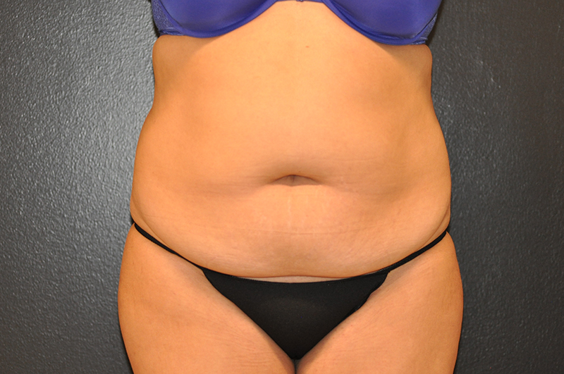 Front View Tummy Tuck Before and After Photo by Dr. Steely in Houston, TX