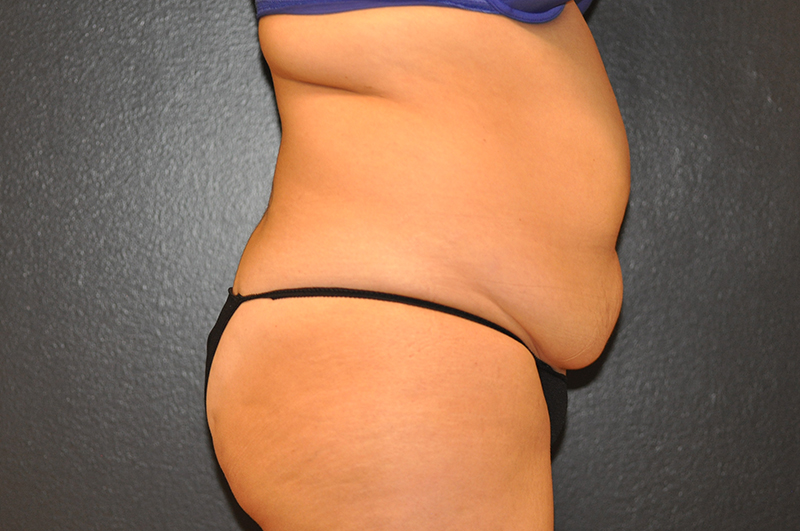 Right Side View Tummy Tuck Before and After Photo by Dr. Steely in Houston, TX