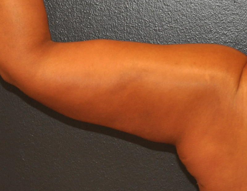 Back Left Side View Arm Lift Before and After Photo by Dr. Steely in Houston, TX