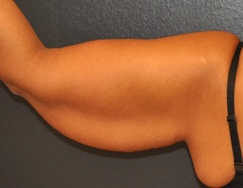 Back Left Side View Arm Lift Before and After Photo by Dr. Steely in Houston, TX