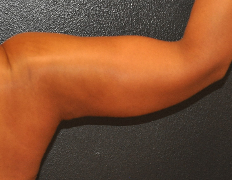 Back Right Side View Arm Lift Before and After Photo by Dr. Steely in Houston, TX