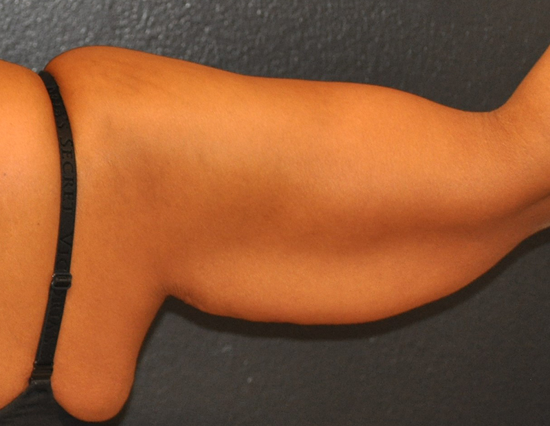 Back Right Side View Arm Lift Before and After Photo by Dr. Steely in Houston, TX