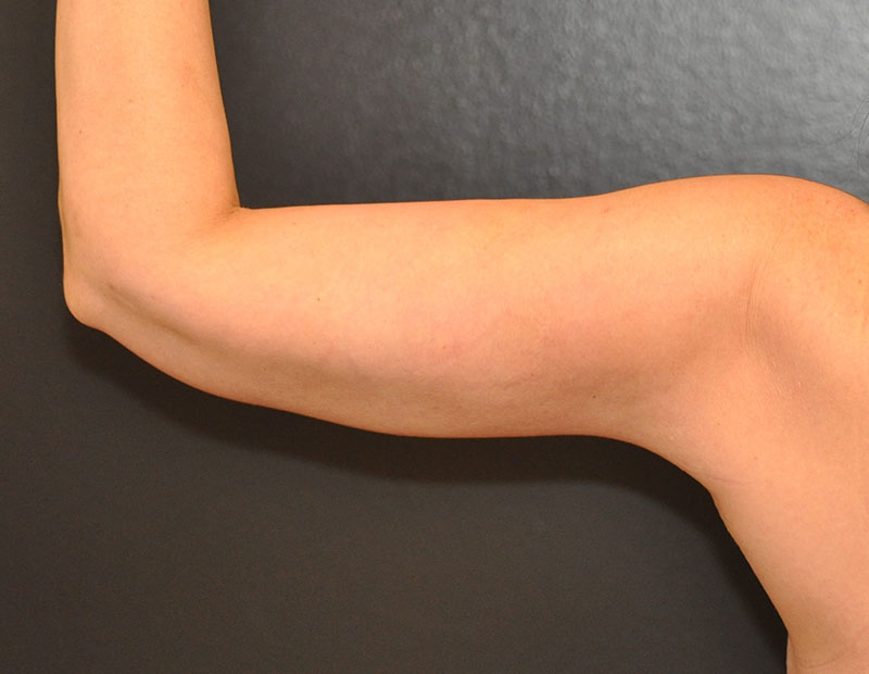 Back left side view Arm Lift Before and After Photo by Dr. Steely in Houston, TX