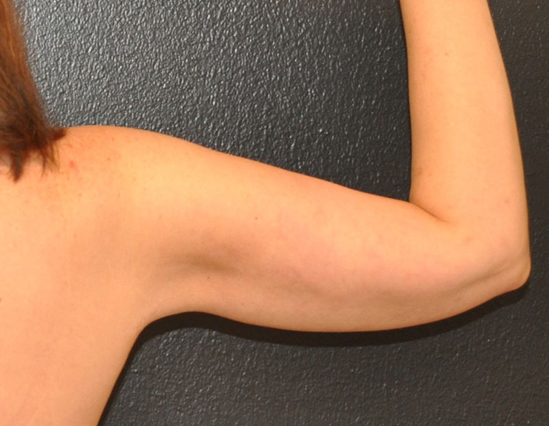 Back right side view Arm Lift Before and After Photo by Dr. Steely in Houston, TX