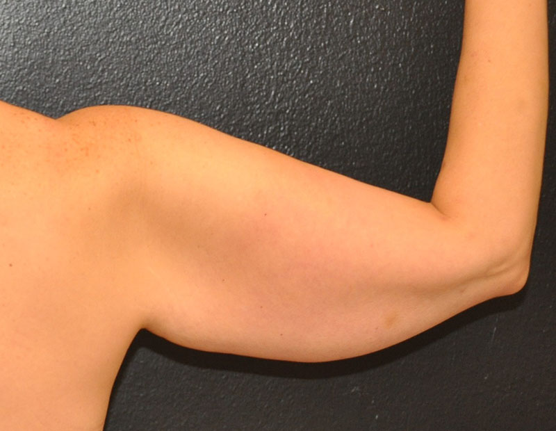 Back right side view Arm Lift Before and After Photo by Dr. Steely in Houston, TX