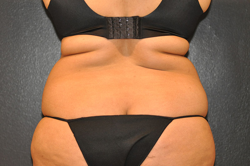 Back View Tummy Tuck Before and After Photo by Dr. Steely in Houston, TX