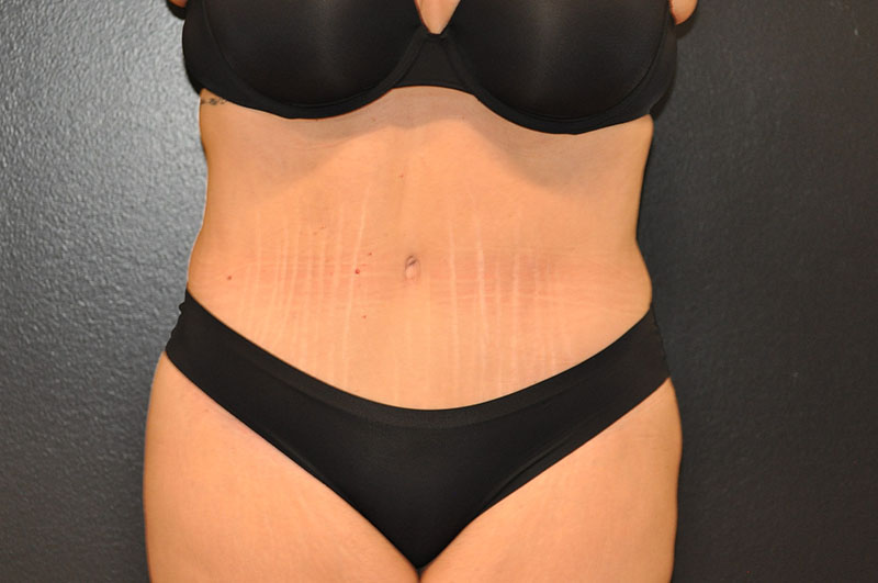 Front View Body Lift Before and After Photo by Dr. Steely in Houston, TX