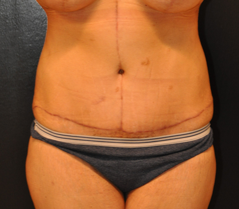 Front View Body Lift Before and After Photo by Dr. Steely in Houston, TX