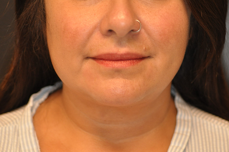 Front View Chin and Jawline Liposuction Before and After Photo by Dr. Steely in Houston, TX