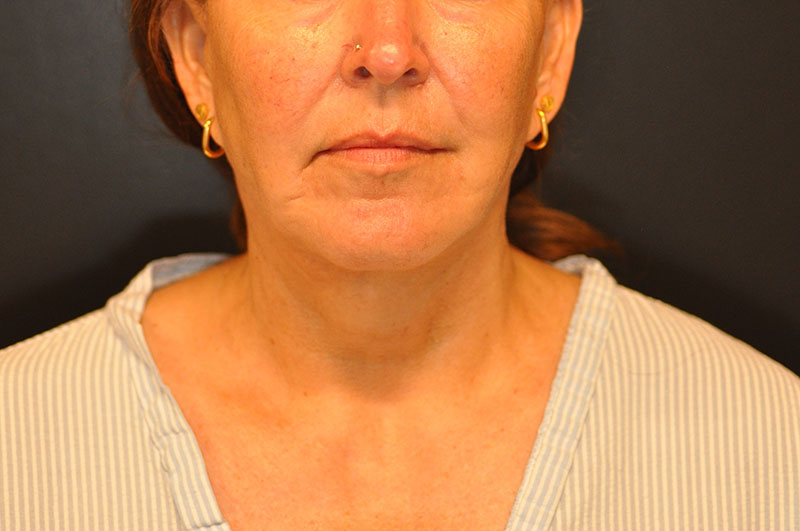 Front View Facelift Before and After Photo by Dr. Steely in Houston, TX