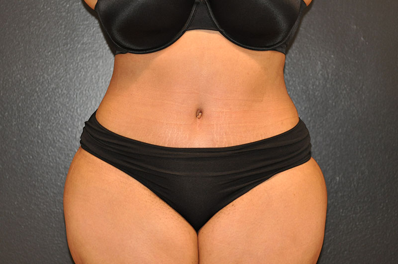 Front View Tummy Tuck Before and After Photo by Dr. Steely in Houston, TX