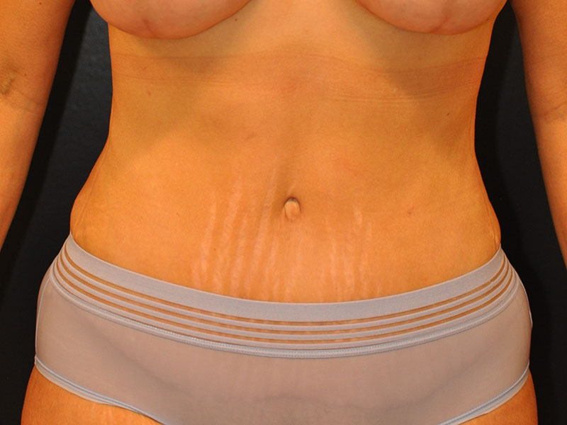 Front View Tummy Tuck Before and After Photo by Dr. Steely in Houston, TX