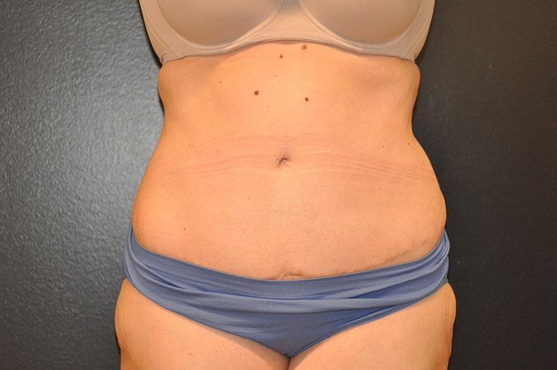 Front View Tummy Tuck Before and After Photo by Dr. Steely in Houston, TX