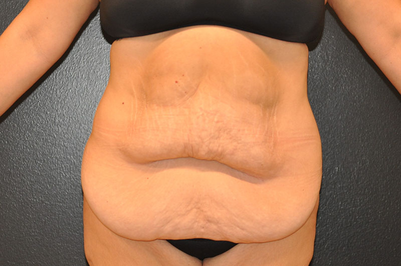 Front View Body Lift Before and After Photo by Dr. Steely in Houston, TX