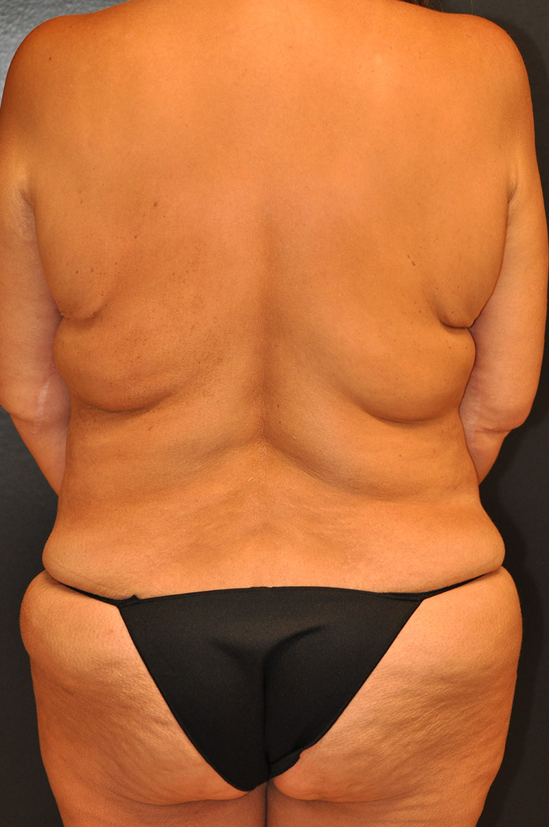 Front View Body Lift Before and After Photo by Dr. Steely in Houston, TX
