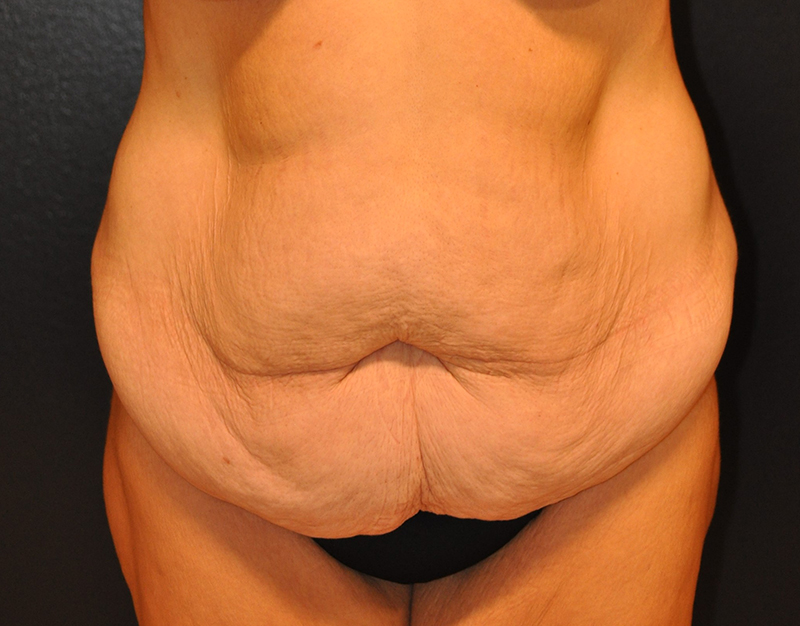 Front View Body Lift Before and After Photo by Dr. Steely in Houston, TX