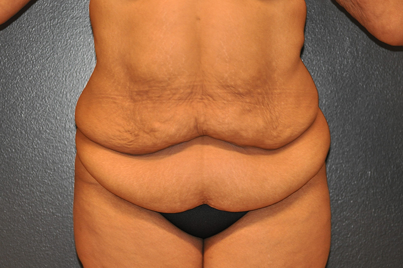 Front View Body Lift Before and After Photo by Dr. Steely in Houston, TX
