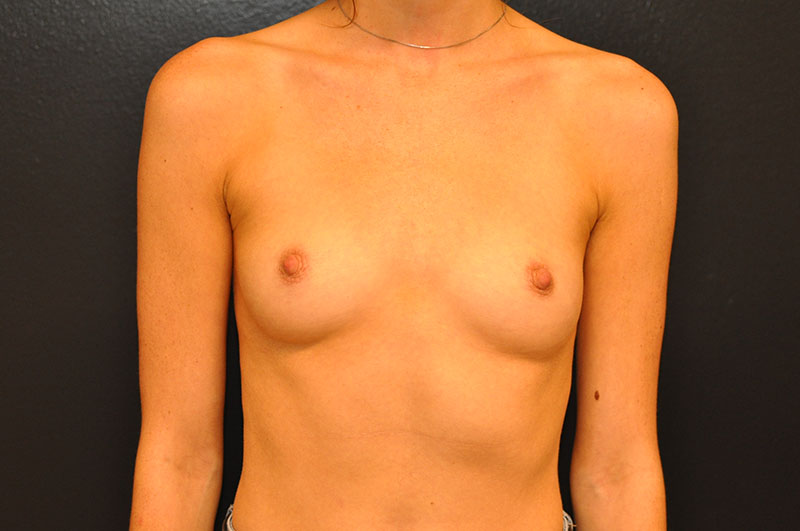 Front View Breast Augmentation Before and After Photo by Dr. Steely in Houston, TX