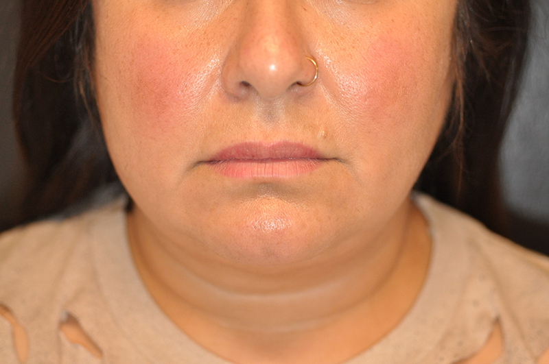 Front View Chin and Jawline Liposuction Before and After Photo by Dr. Steely in Houston, TX