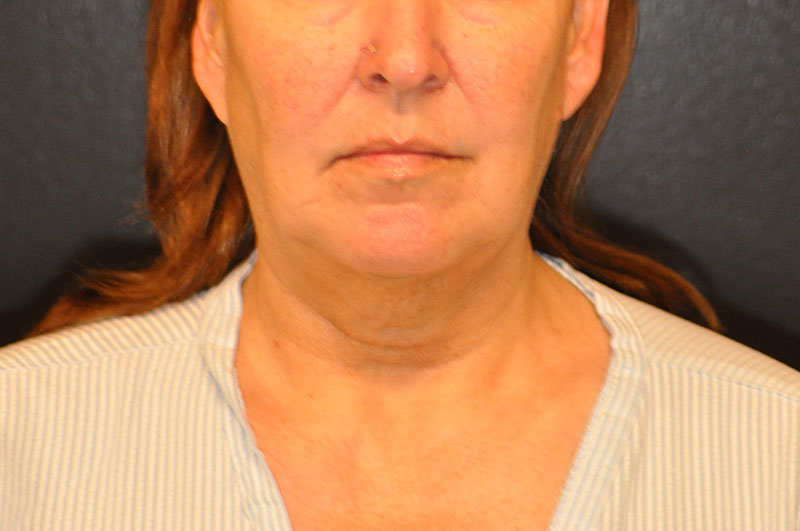 Front View Facelift Before and After Photo by Dr. Steely in Houston, TX