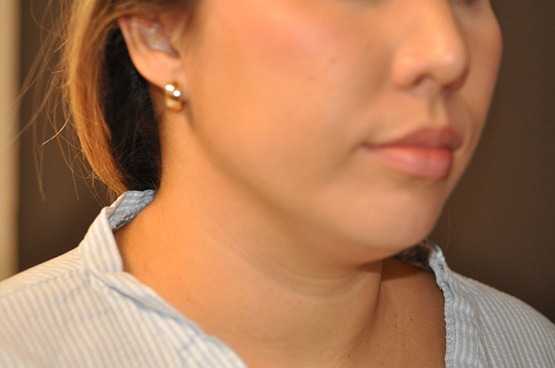 Front View Liposuction Before and After Photo by Dr. Steely in Houston, TX