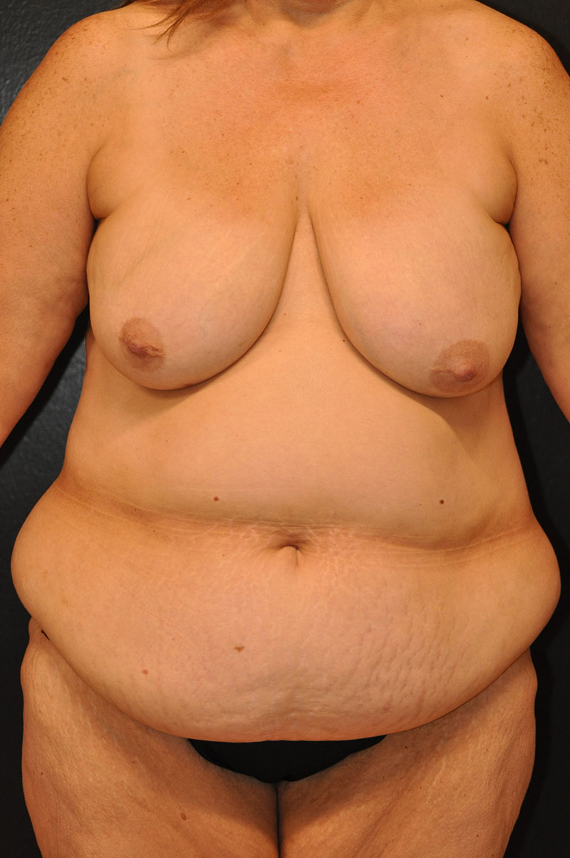 Front View Mommy Makeover Before and After Photo by Dr. Steely in Houston, TX