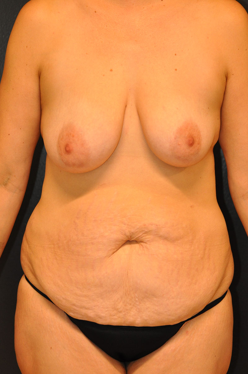 Front View Mommy Makeover Before and After Photo by Dr. Steely in Houston, TX