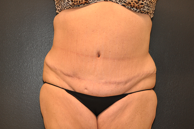 Front View Plastic Surgery Revision Before and After Photo by Dr. Steely in Houston, TX