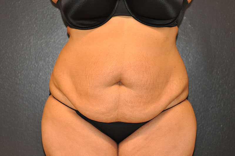 Front View Tummy Tuck Before and After Photo by Dr. Steely in Houston, TX