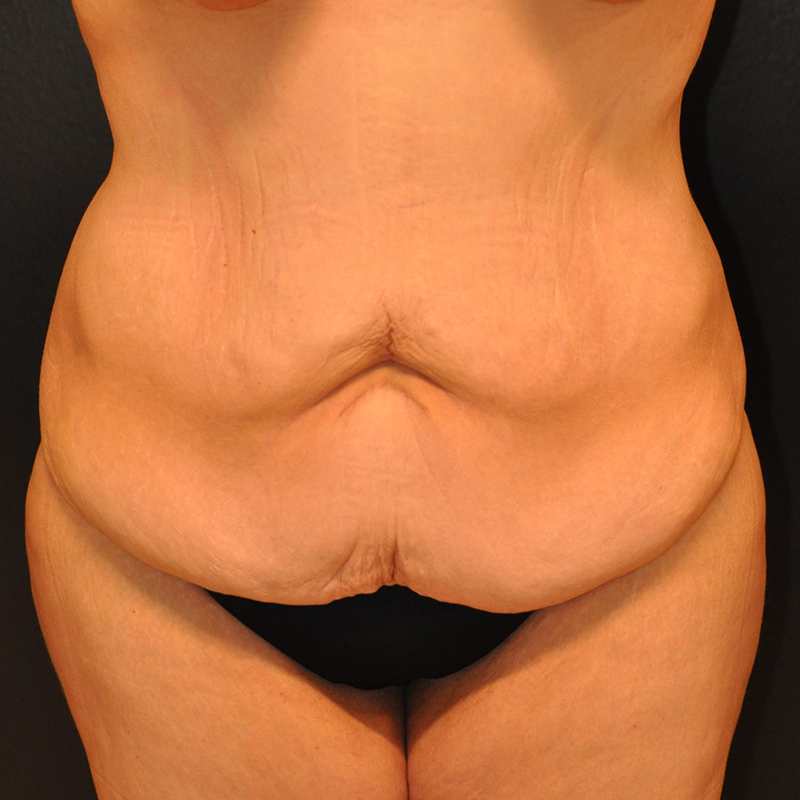 Front View Tummy Tuck Before and After Photo by Dr. Steely in Houston, TX