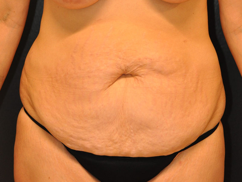 Front View Tummy Tuck Before and After Photo by Dr. Steely in Houston, TX