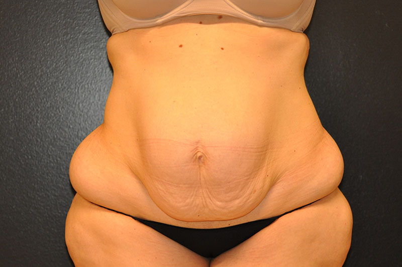 Front View Tummy Tuck Before and After Photo by Dr. Steely in Houston, TX