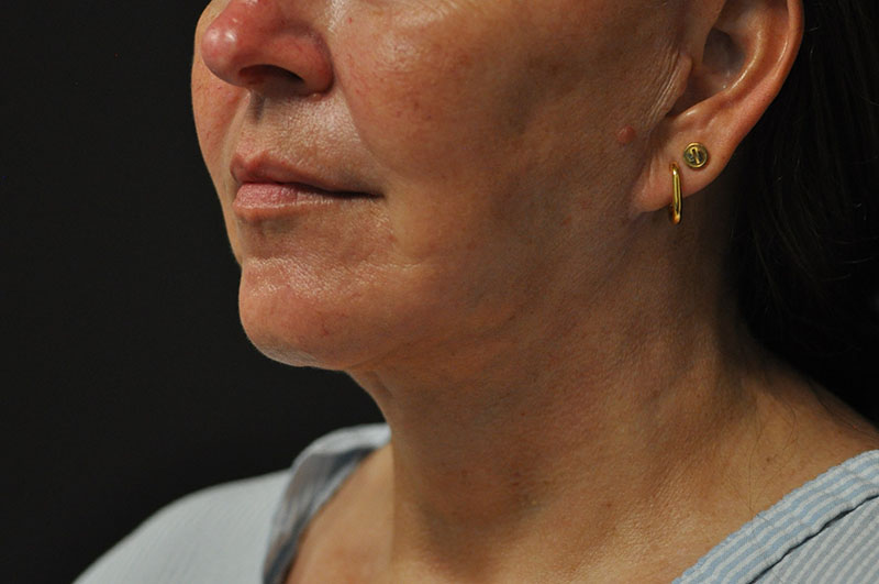 Left Oblique View Facelift Before and After Photo by Dr. Steely in Houston, TX